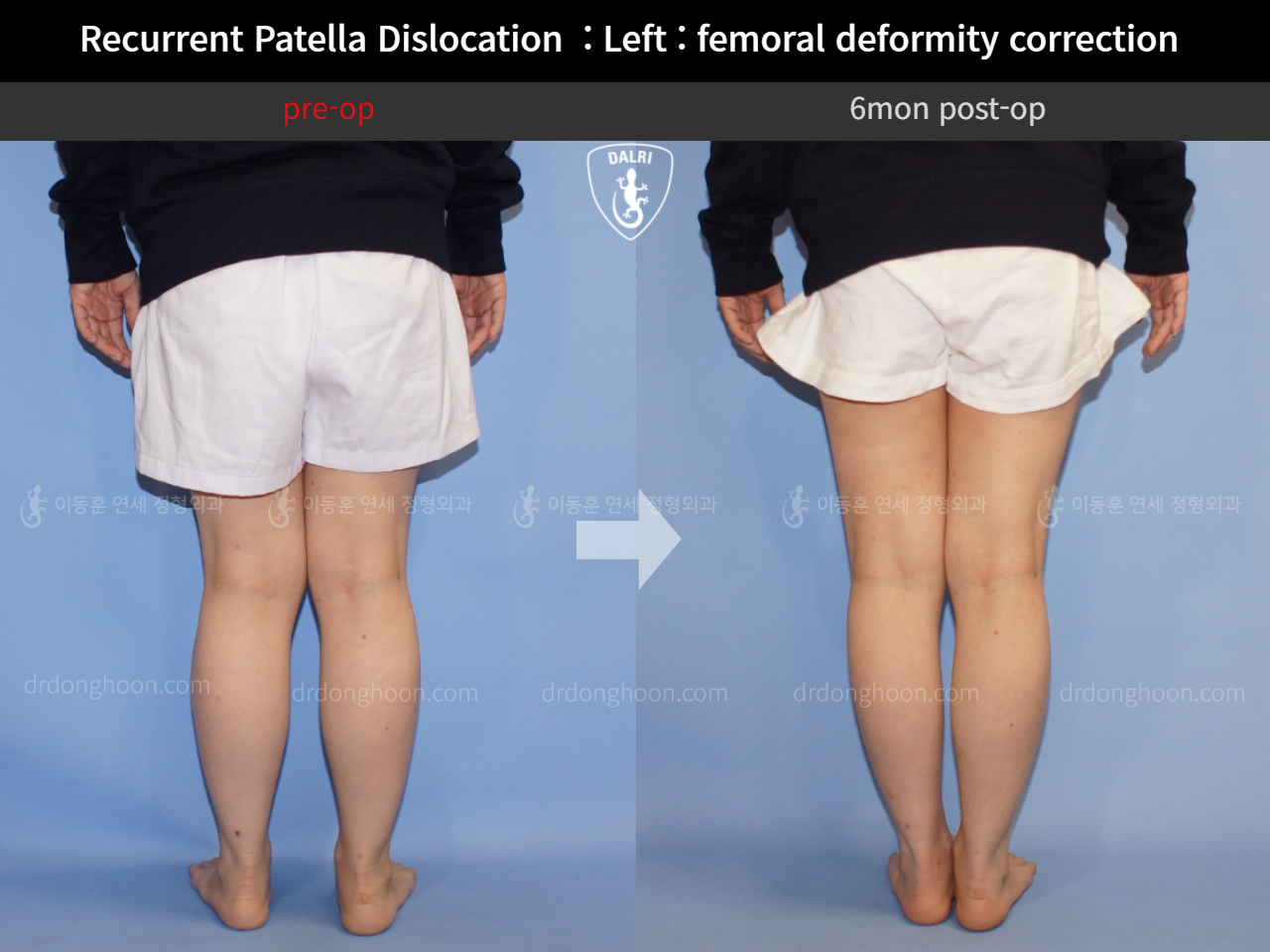 Before and after adult knock knees, case 10546874, image 4, Dr. Donghoon institute (DALRI)