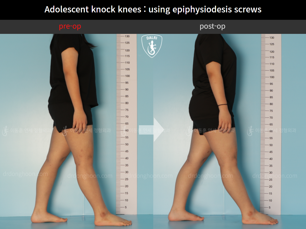 Before and after paediatric & adolescent knock knees, case 11123118, image 4, Dr. Donghoon institute (DALRI)