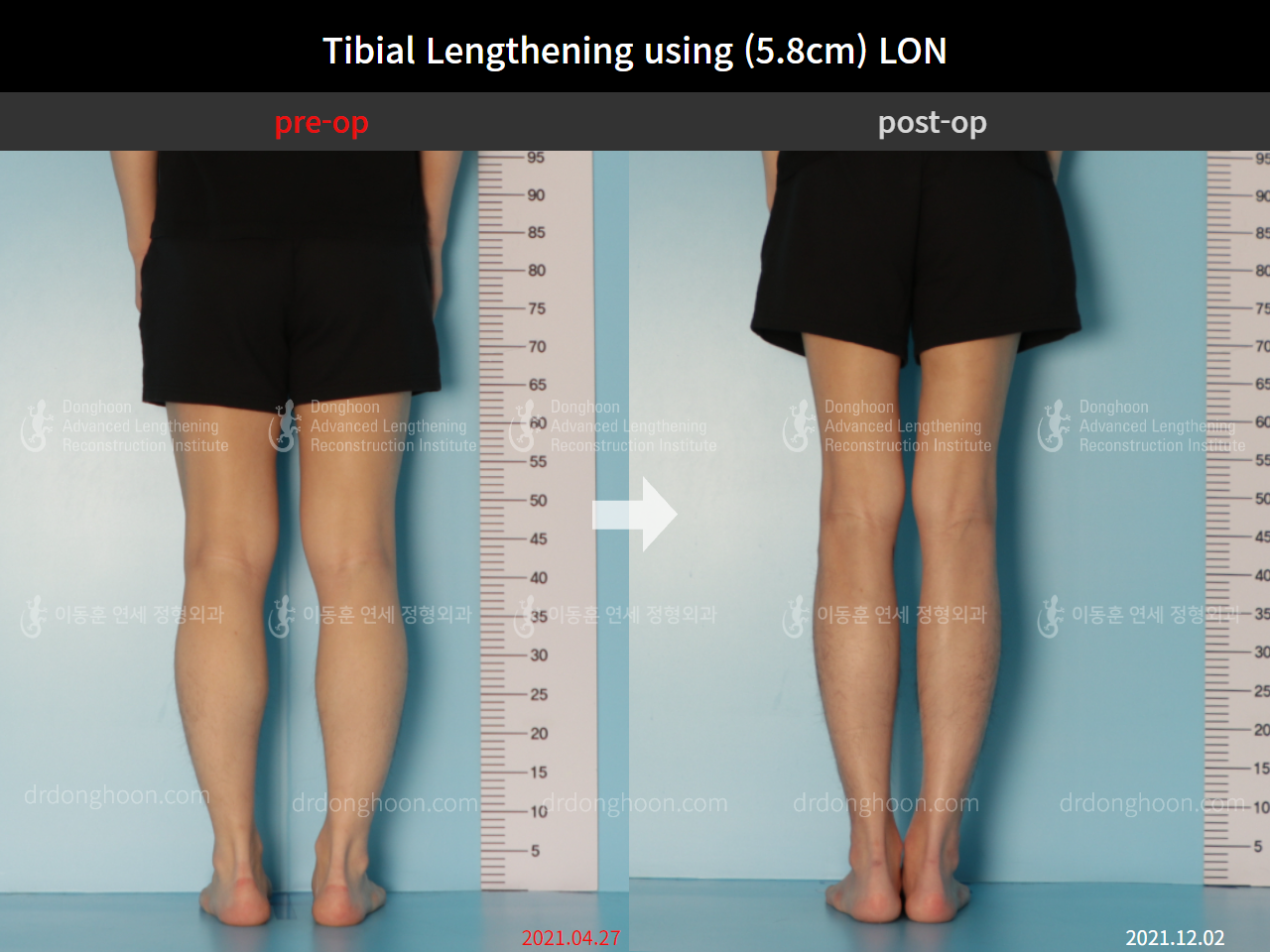 Before and after cll lon, case 9047470, image 4, Dr. Donghoon institute (DALRI)
