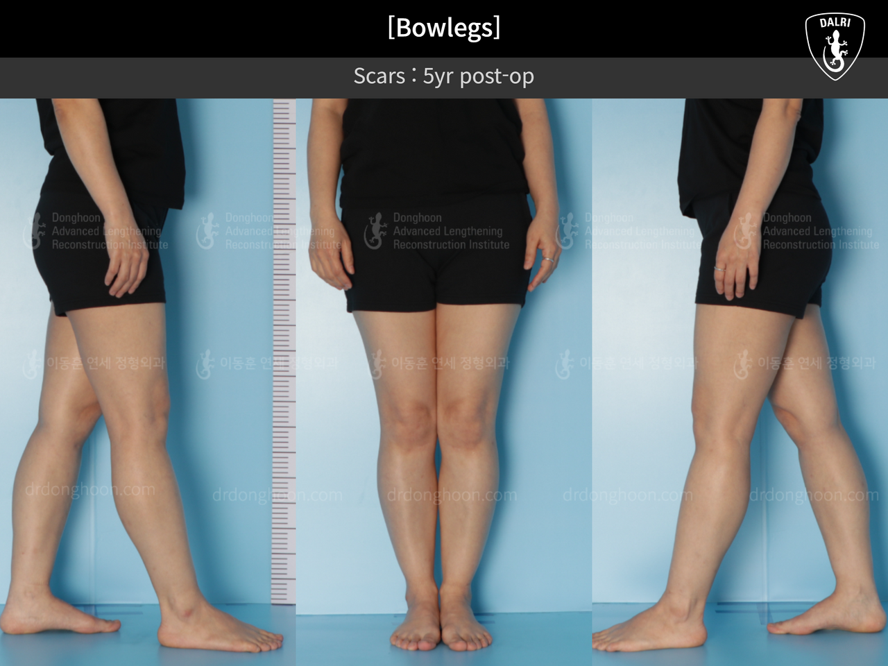 Before and after adult bowlegs, case 13567064, image 5, Dr. Donghoon institute (DALRI)