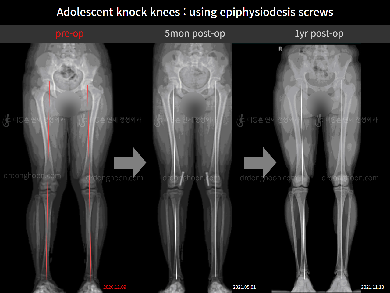 Before and after paediatric & adolescent knock knees, case 11123118, image 9, Dr. Donghoon institute (DALRI)
