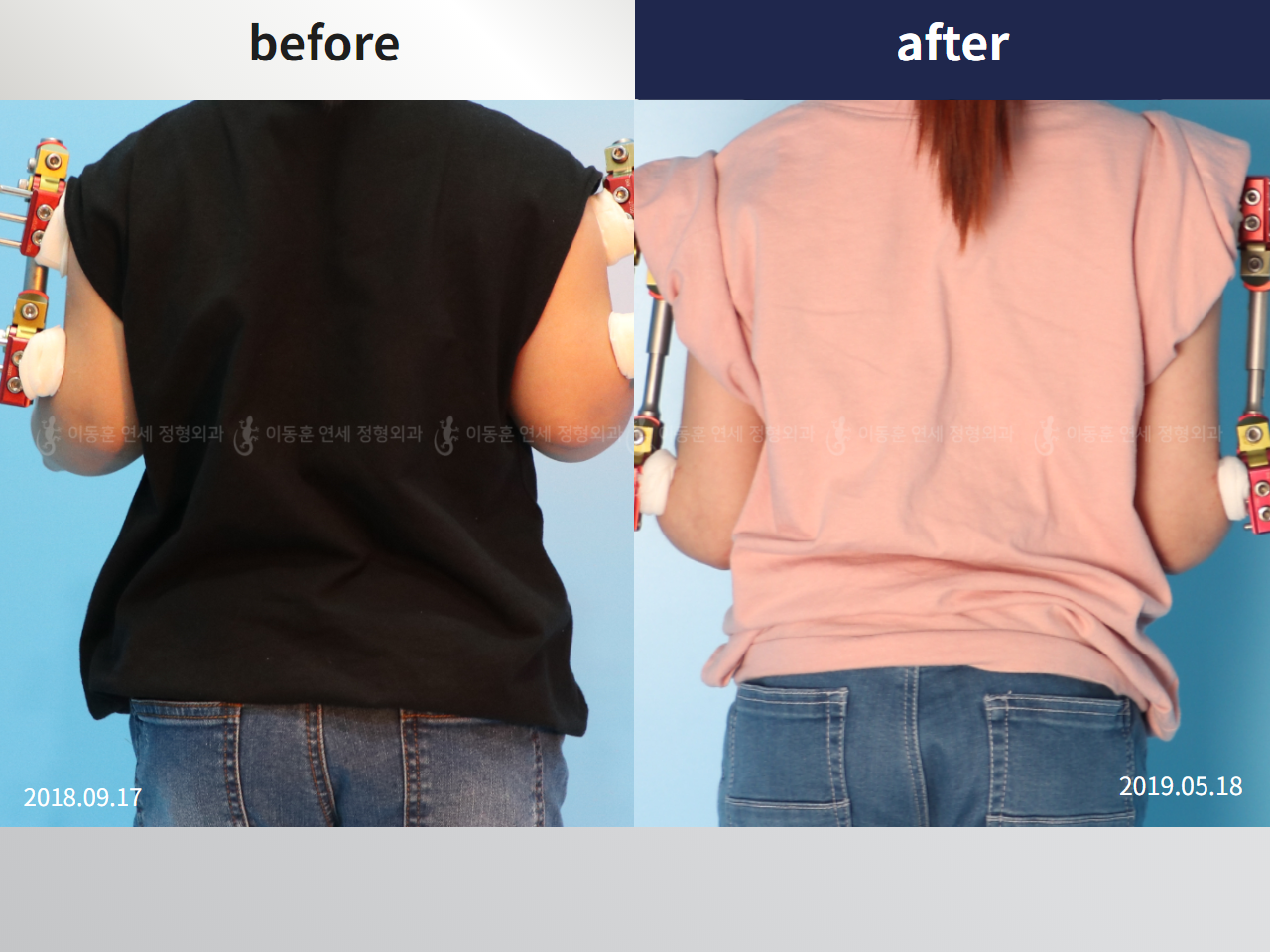 Before and after arm lengthening, case 4249492, image 1, Dr. Donghoon institute (DALRI)