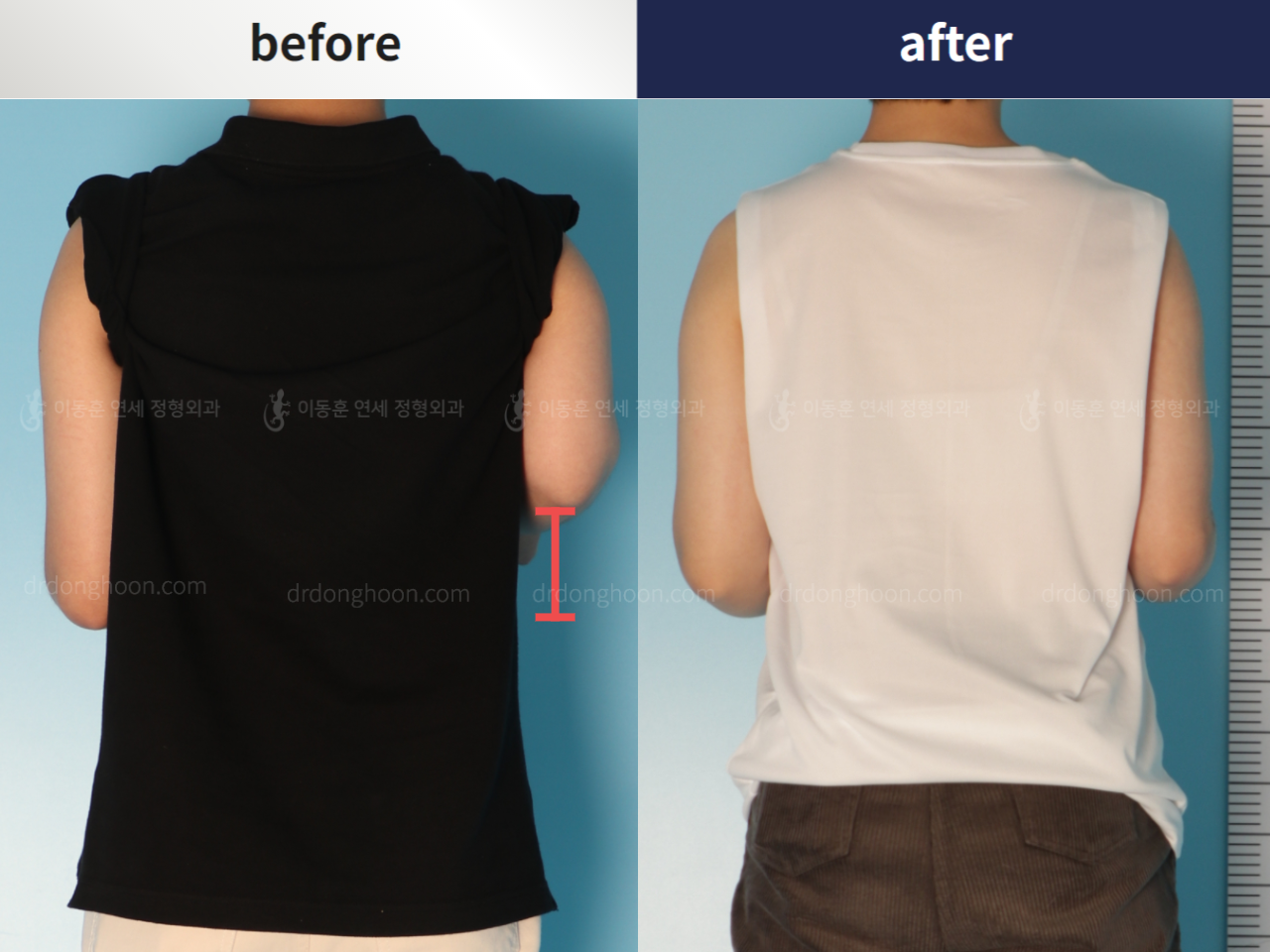 Before and after arm lengthening, case 5456644, image 2, Dr. Donghoon institute (DALRI)