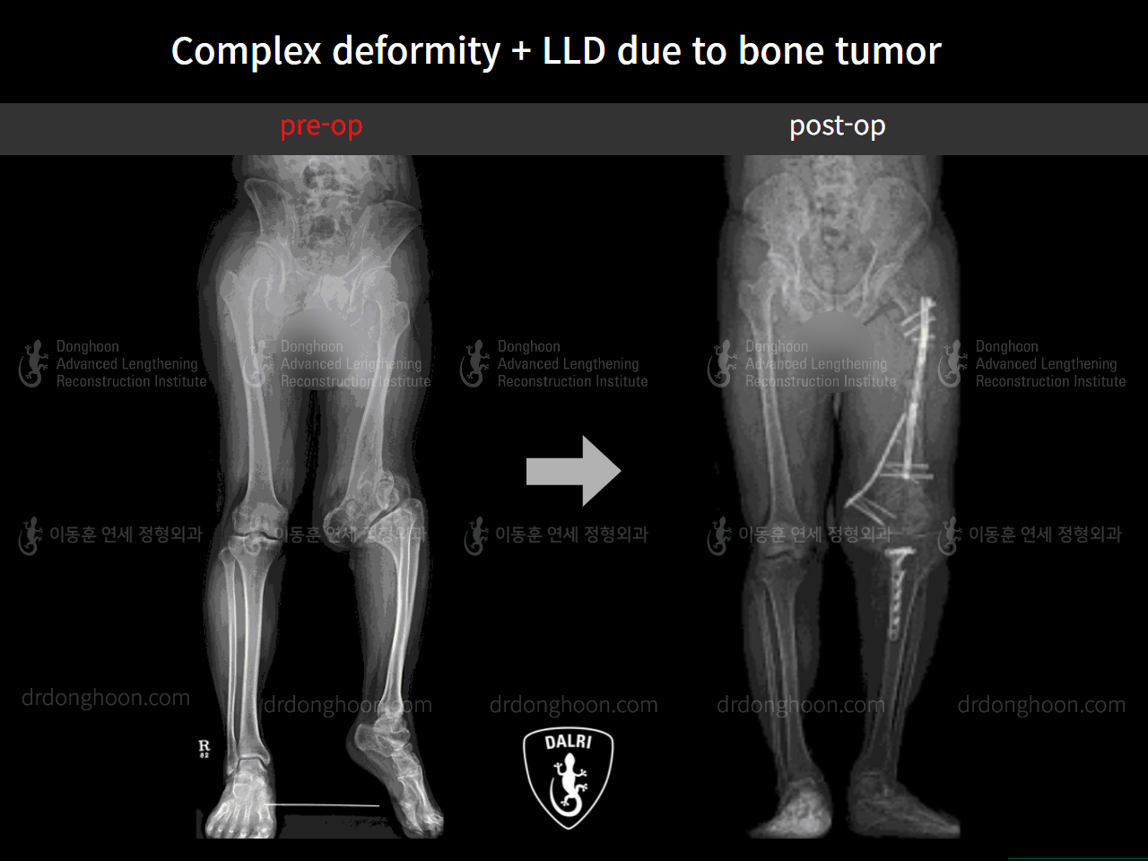 Before and after adult lld, case 9107741, image 3, Dr. Donghoon institute (DALRI)