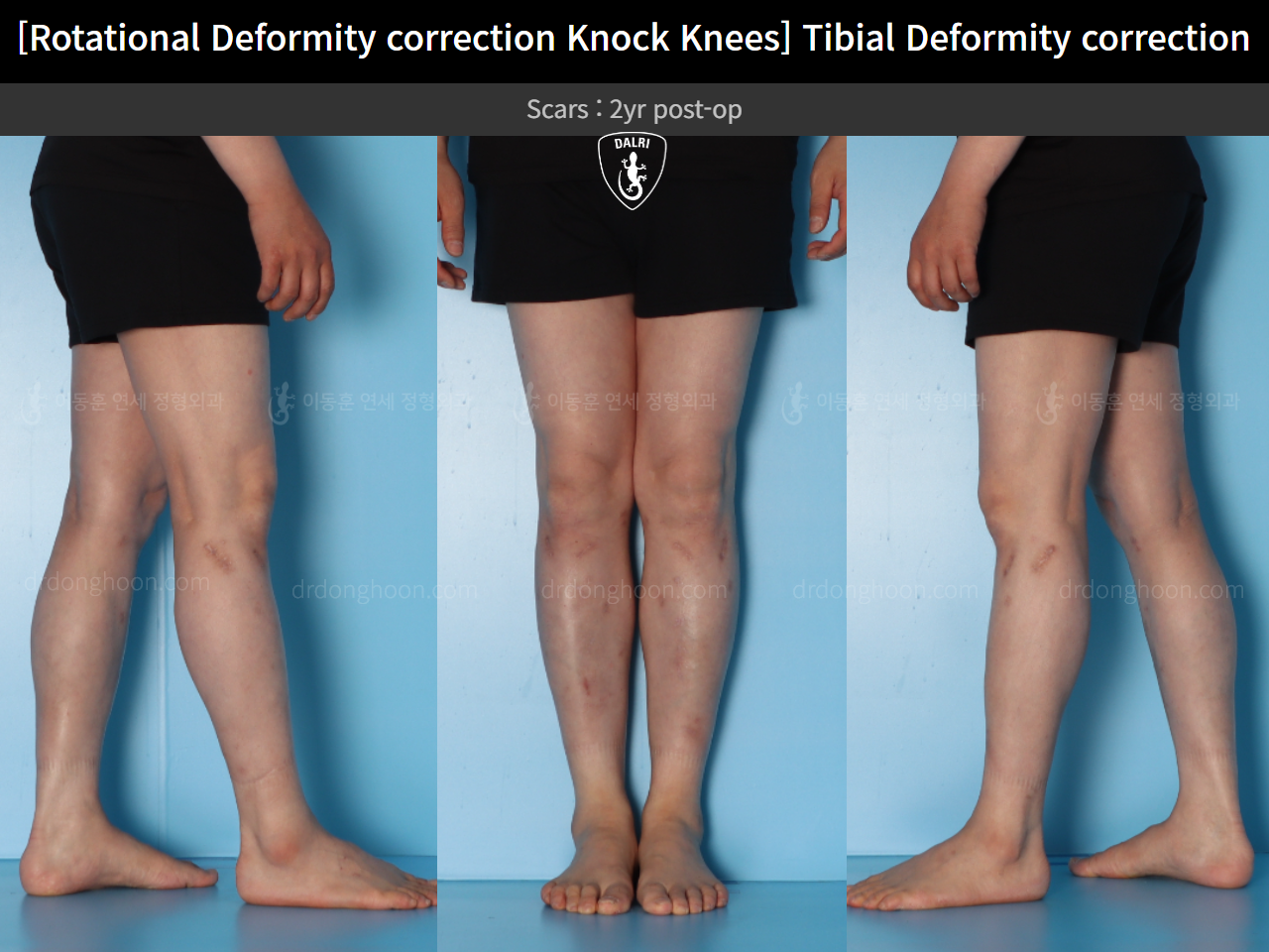 Before and after adult knock knees, case 15524370, image 9, Dr. Donghoon institute (DALRI)