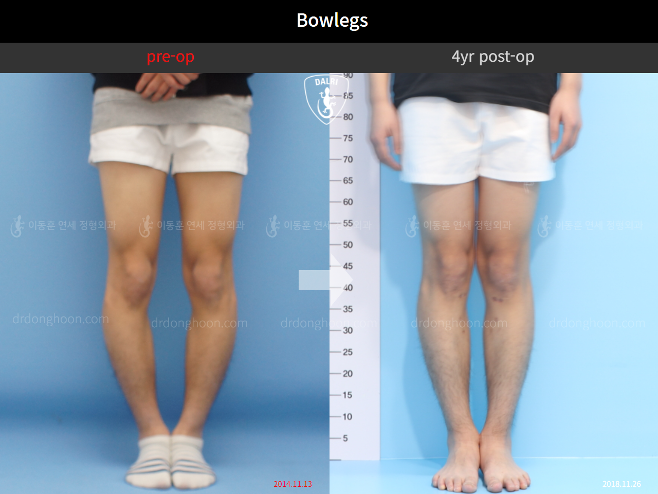 Before and after adult bowlegs, case 4311360, image 5, Dr. Donghoon institute (DALRI)
