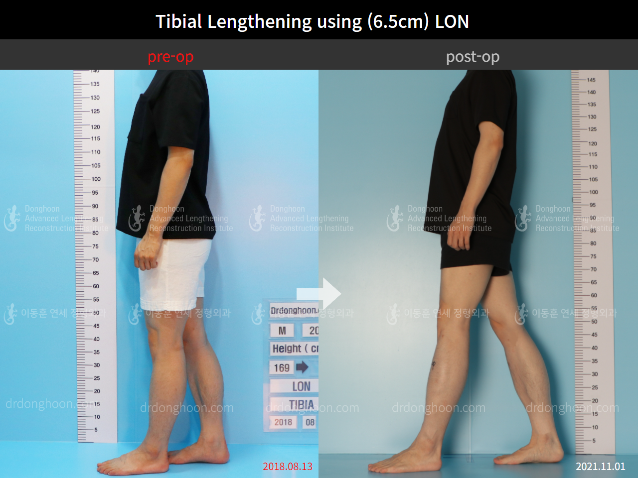 Before and after cll lon, case 8777040, image 4, Dr. Donghoon institute (DALRI)