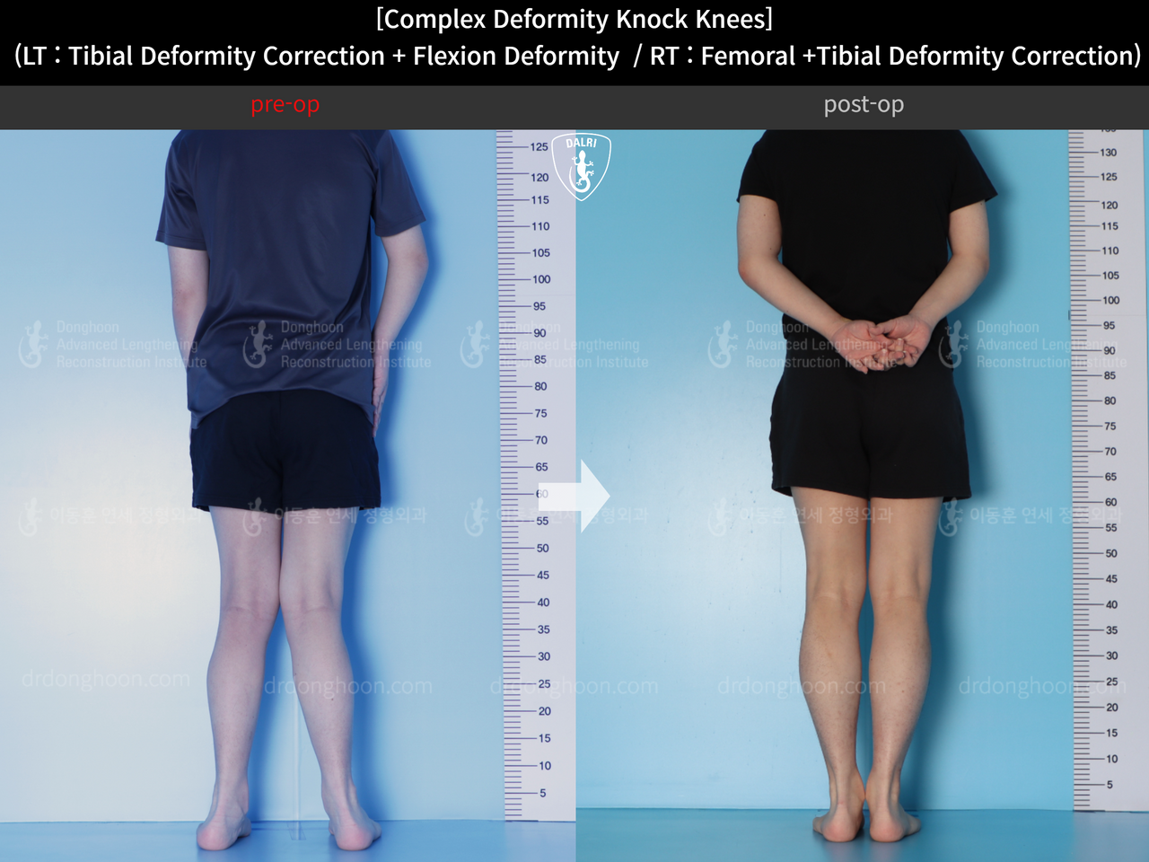 Before and after adult knock knees, case 14439339, image 4, Dr. Donghoon institute (DALRI)