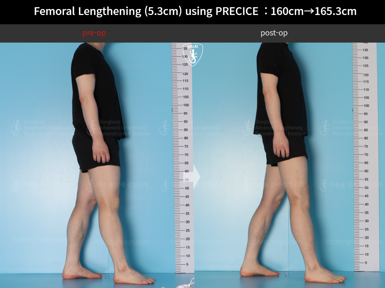 Before and after cll precice, case 18250566, image 3, Dr. Donghoon institute (DALRI)