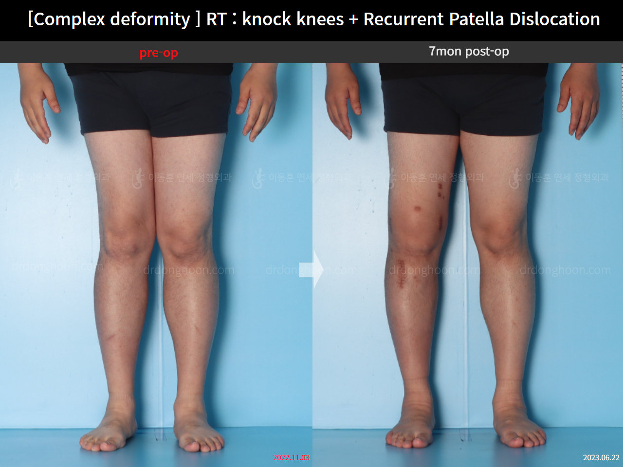 Before and after recurrent patella dislocation, case 16147031, image 7, Dr. Donghoon institute (DALRI)