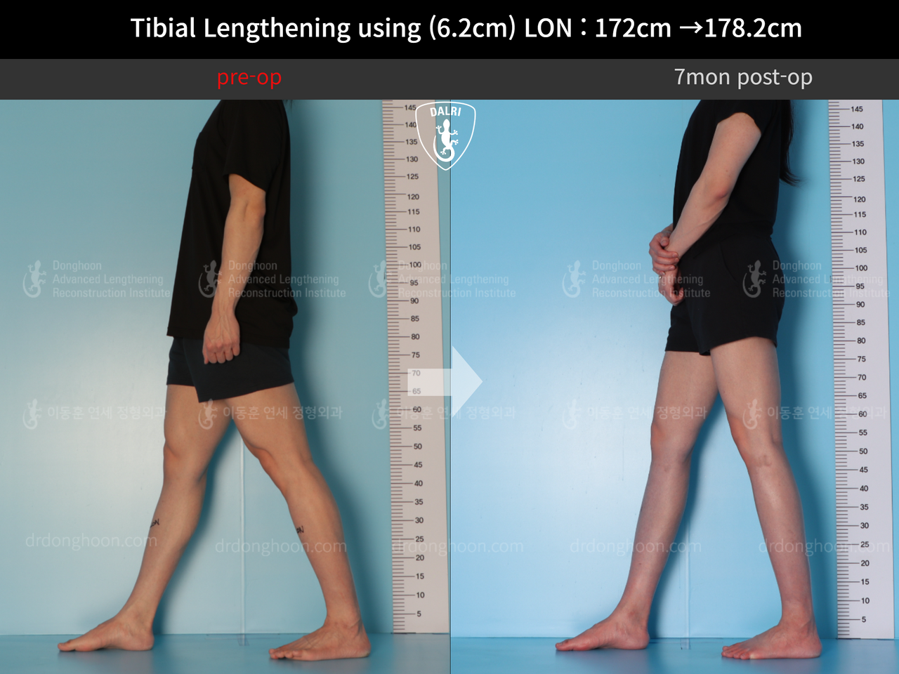 Before and after cll lon, case 12519142, image 3, Dr. Donghoon institute (DALRI)