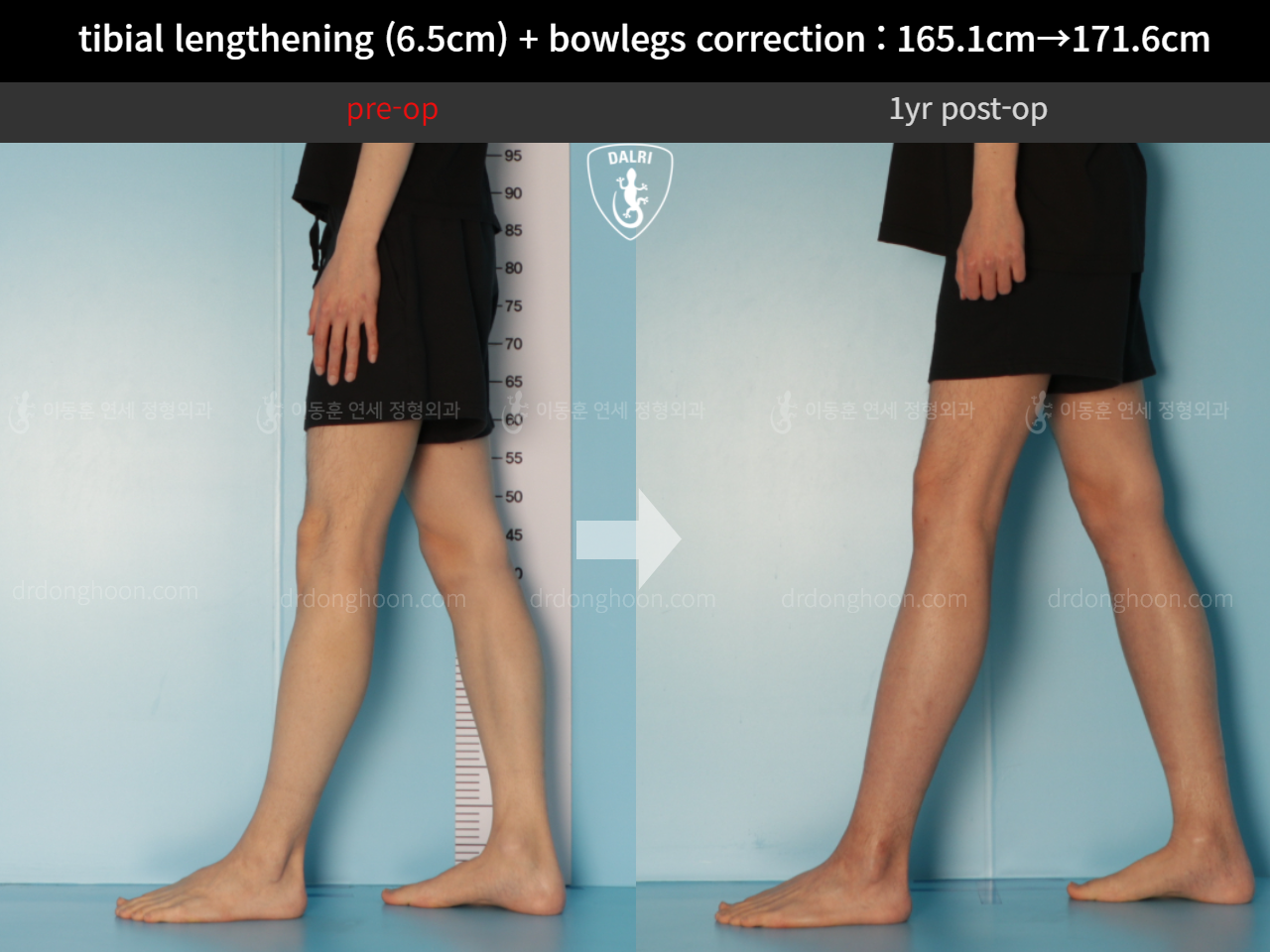 Before and after cll + deformity correction, case 10379185, image 8, Dr. Donghoon institute (DALRI)