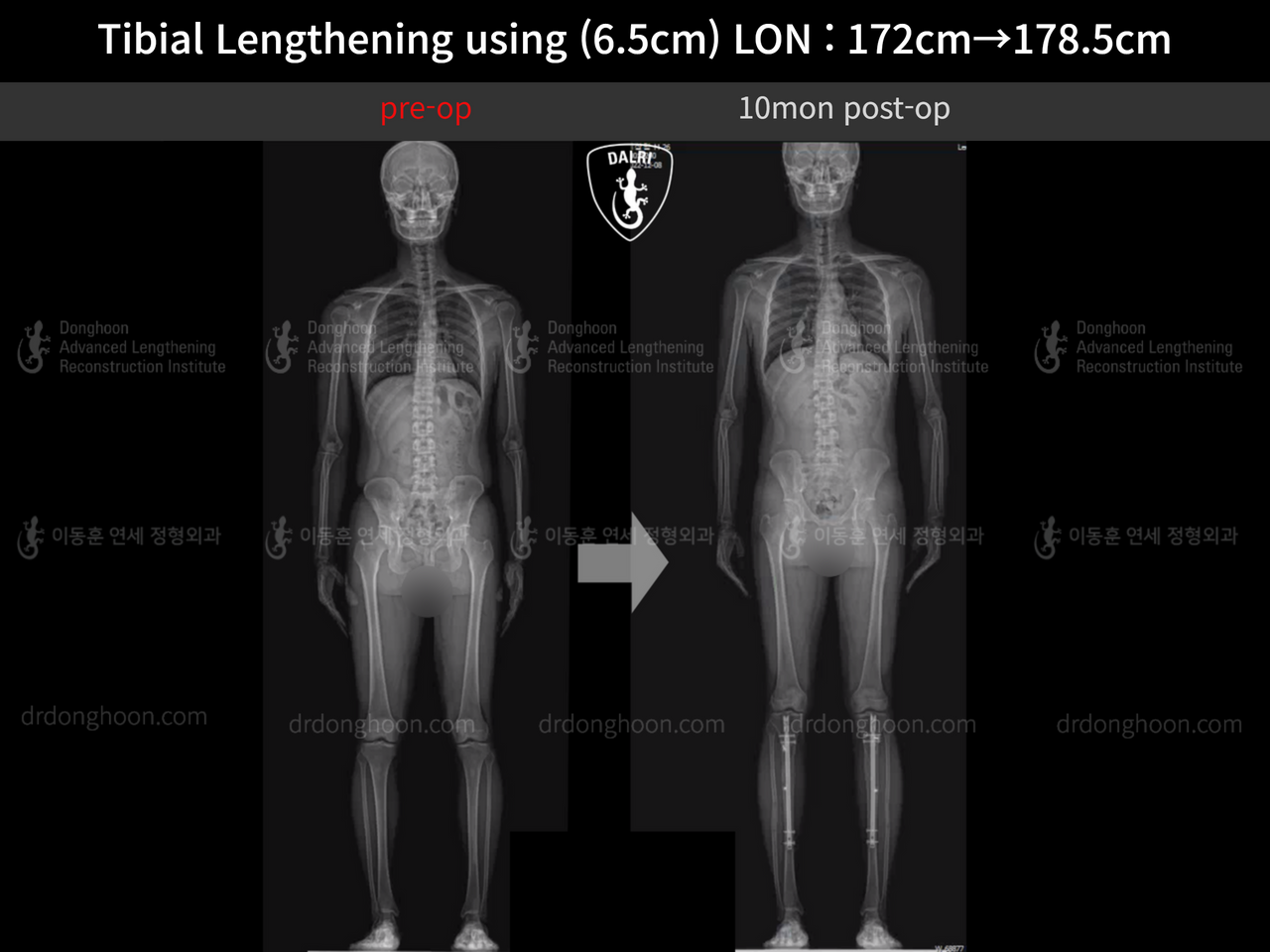 Before and after cll lon, case 13642628, image 7, Dr. Donghoon institute (DALRI)