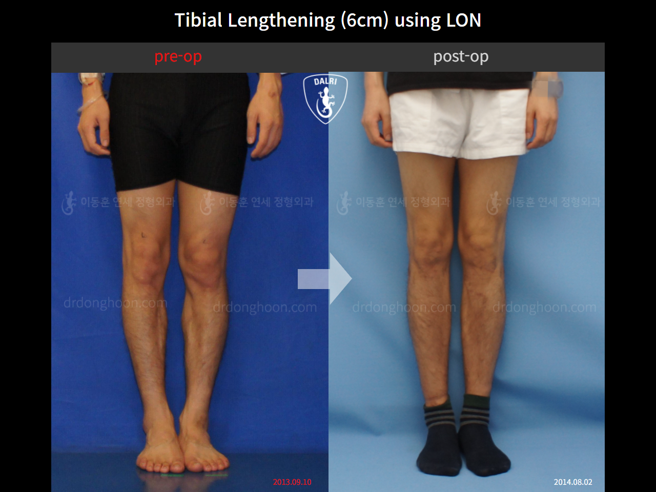 Before and after cll lon, case 4323477, image 3, Dr. Donghoon institute (DALRI)
