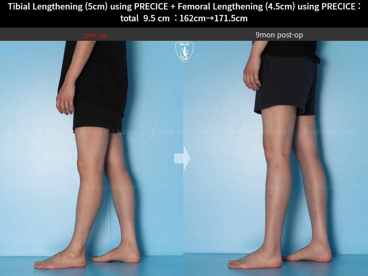 Before and after cll precice, case 15344460, image 12, Dr. Donghoon institute (DALRI)