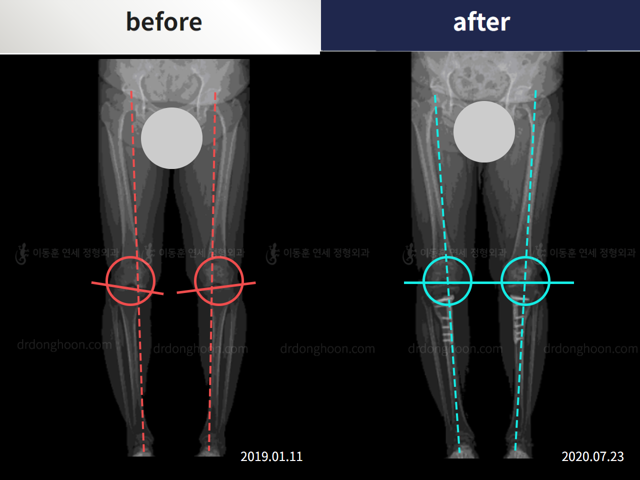 Before and after osteotomy for knee osteoarthritis, case 5302014, image 4, Dr. Donghoon institute (DALRI)