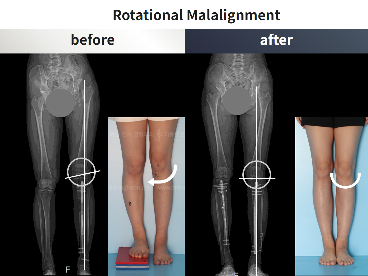 Before and after re-operation for cll, case 4528255, image 4, Dr. Donghoon institute (DALRI)