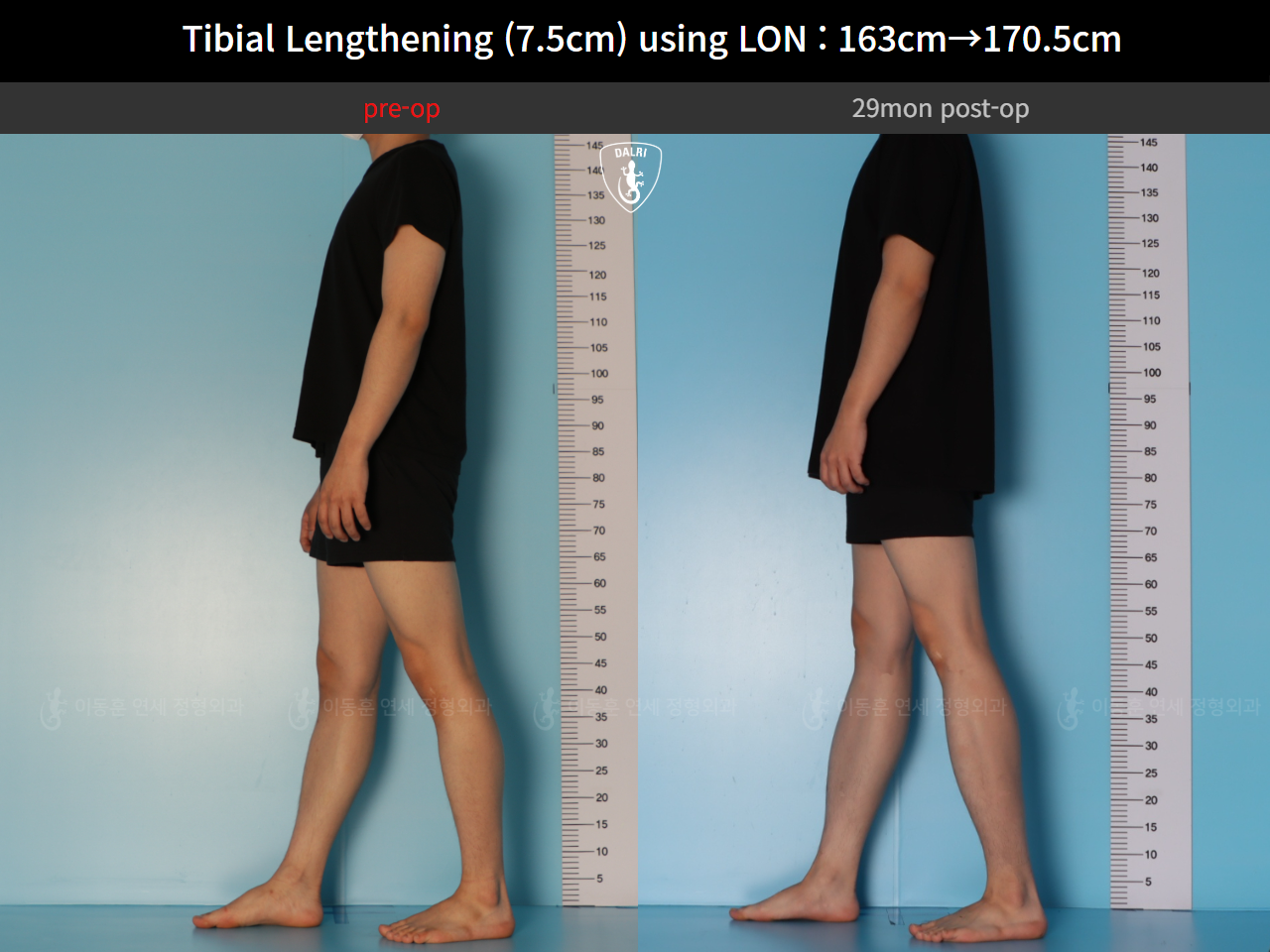 Before and after cll lon, case 127341676, image 6, Dr. Donghoon institute (DALRI)