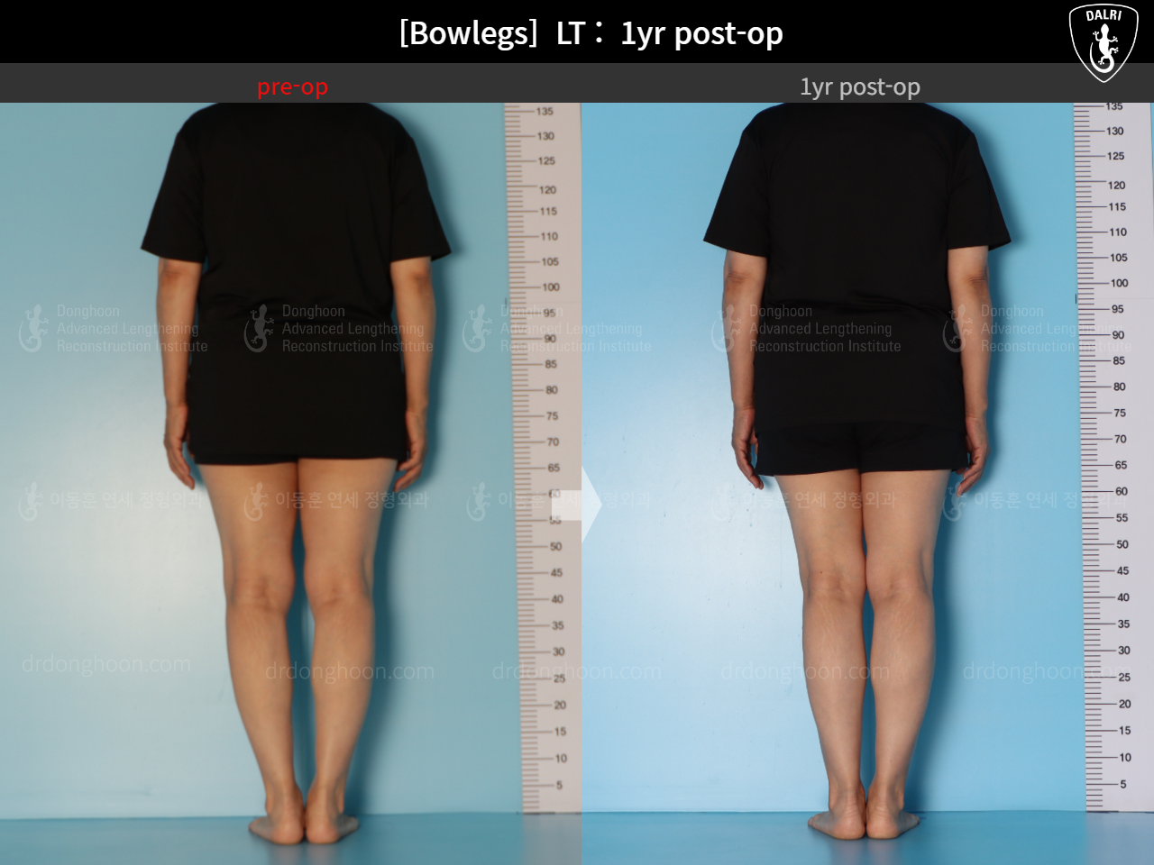 Before and after adult bowlegs, case 15172734, image 7, Dr. Donghoon institute (DALRI)
