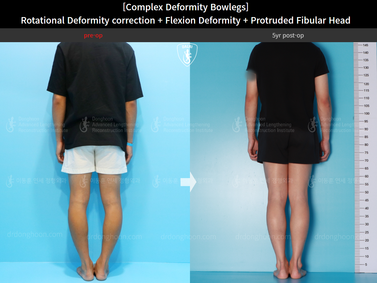 Before and after adult bowlegs, case 15944746, image 4, Dr. Donghoon institute (DALRI)