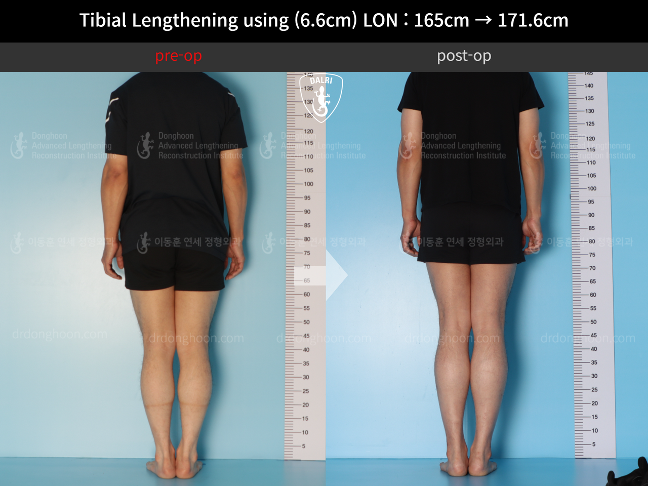 Tibial Lengthening Using (6.6cm) LON : 165cm → 171.6cm : DALRI Before ...