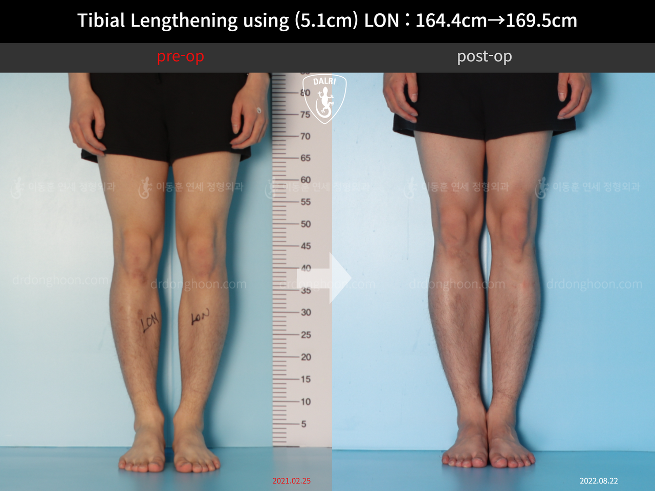 Before and after cll lon, case 12653375, image 5, Dr. Donghoon institute (DALRI)