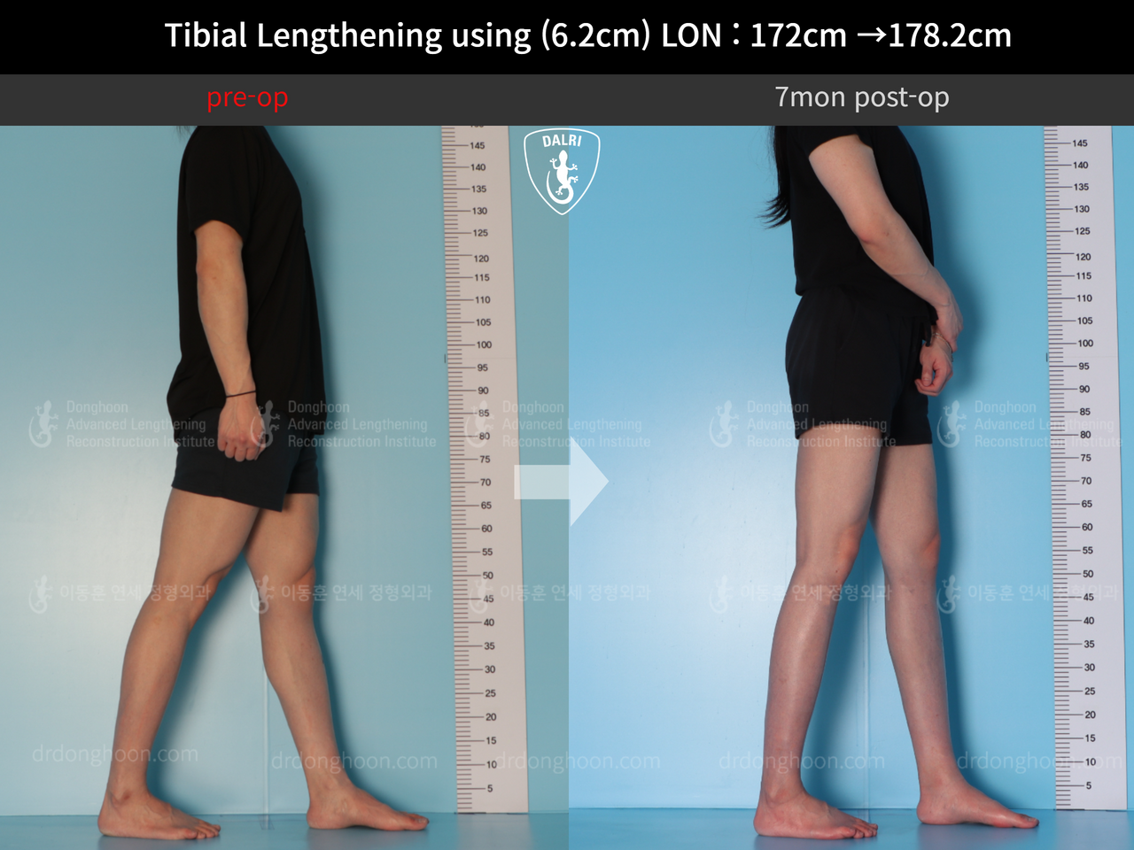 Before and after cll lon, case 12519142, image 4, Dr. Donghoon institute (DALRI)