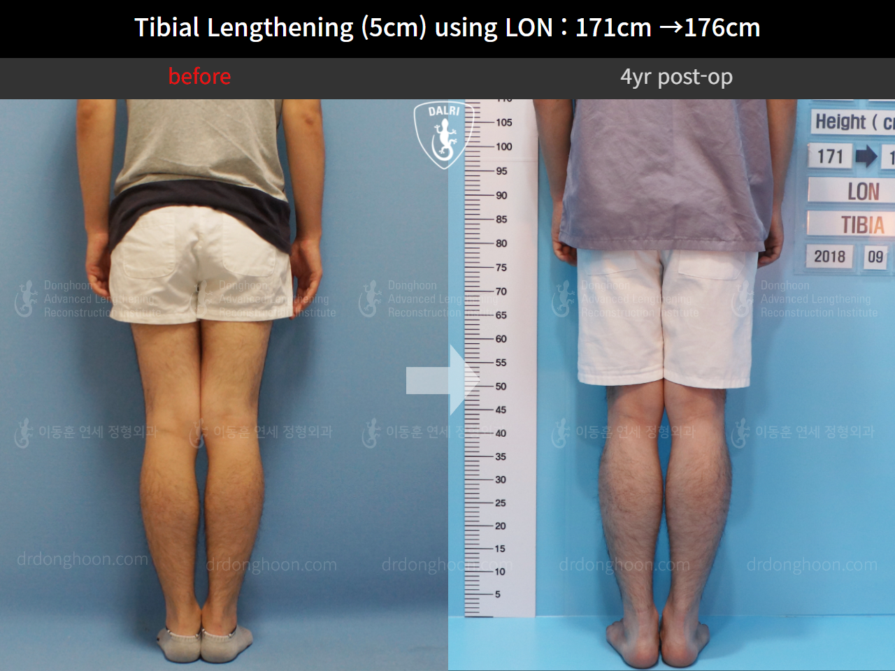 Before and after cll lon, case 4323445, image 4, Dr. Donghoon institute (DALRI)