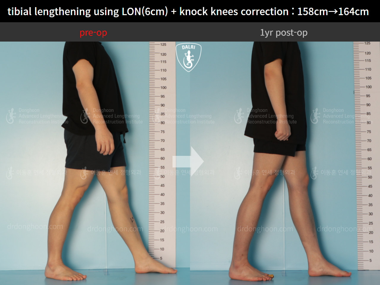 Before and after cll + deformity correction, case 9324521, image 3, Dr. Donghoon institute (DALRI)