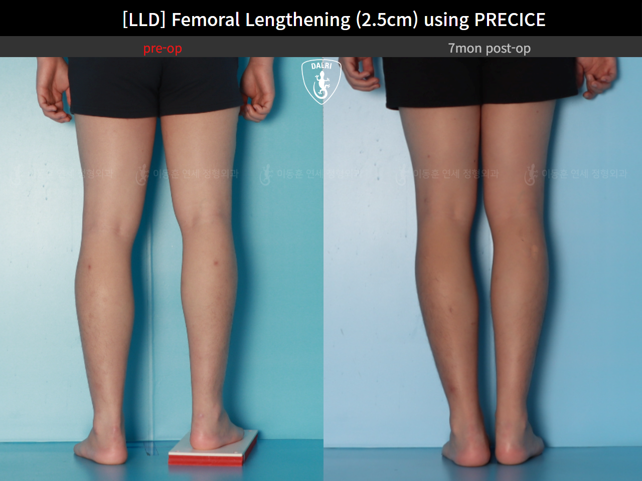 Before and after adult lld, case 127180202, image 6, Dr. Donghoon institute (DALRI)