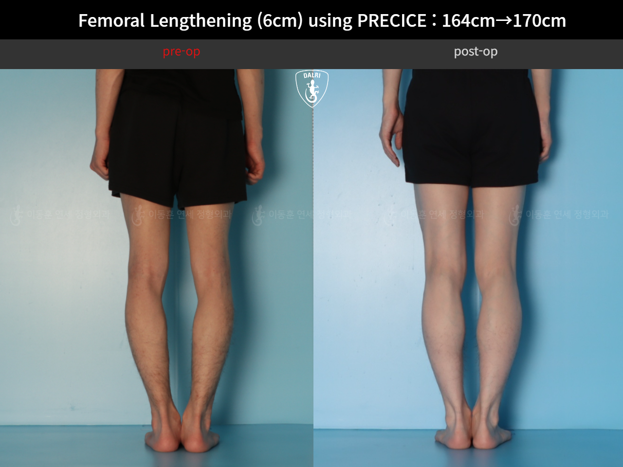 Before and after cll precice, case 33570290, image 8, Dr. Donghoon institute (DALRI)
