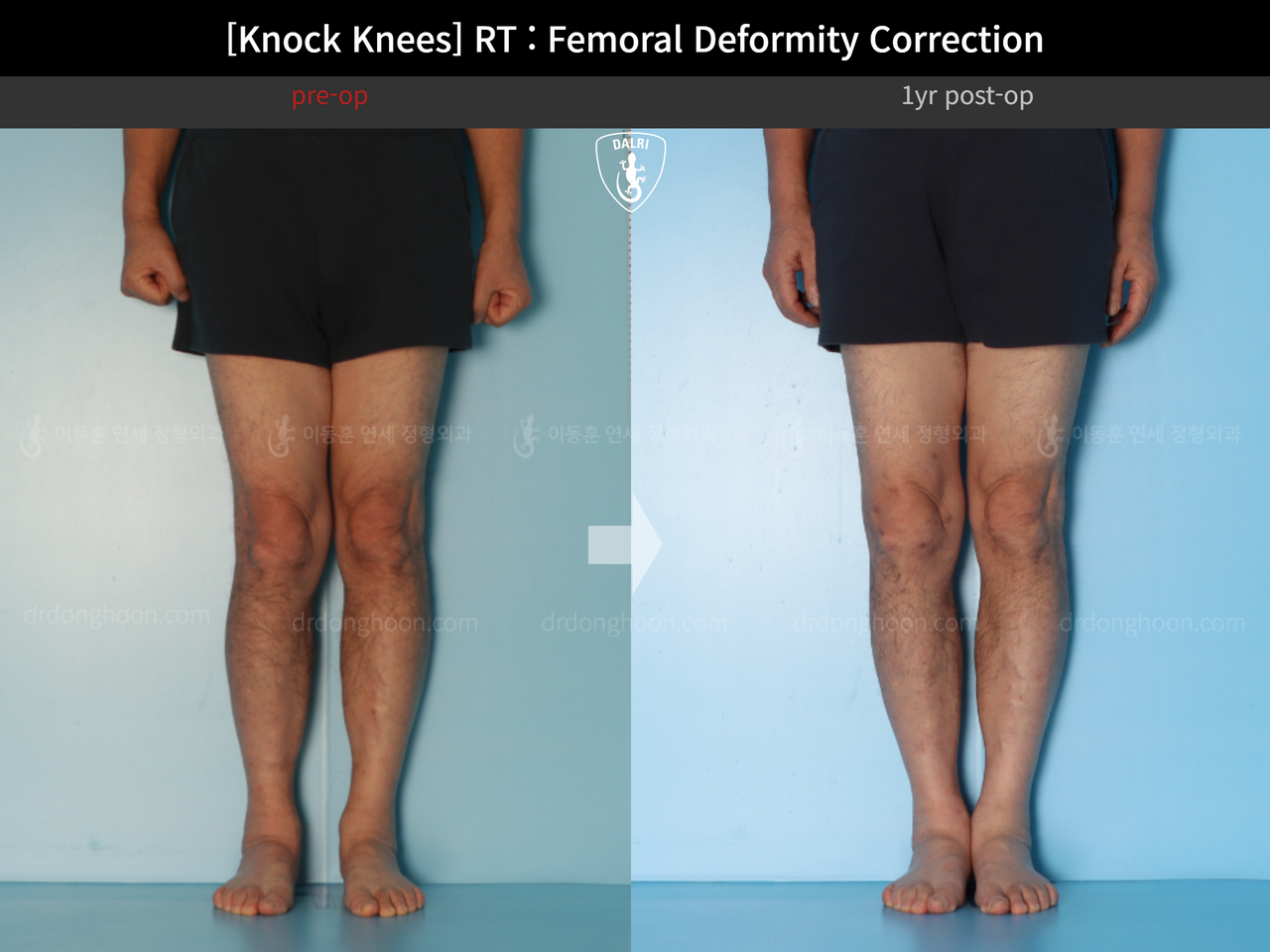 Before and after adult knock knees, case 14236357, image 5, Dr. Donghoon institute (DALRI)