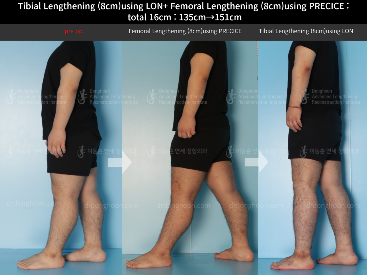 Before and after cll precice, case 12493963, image 3, Dr. Donghoon institute (DALRI)