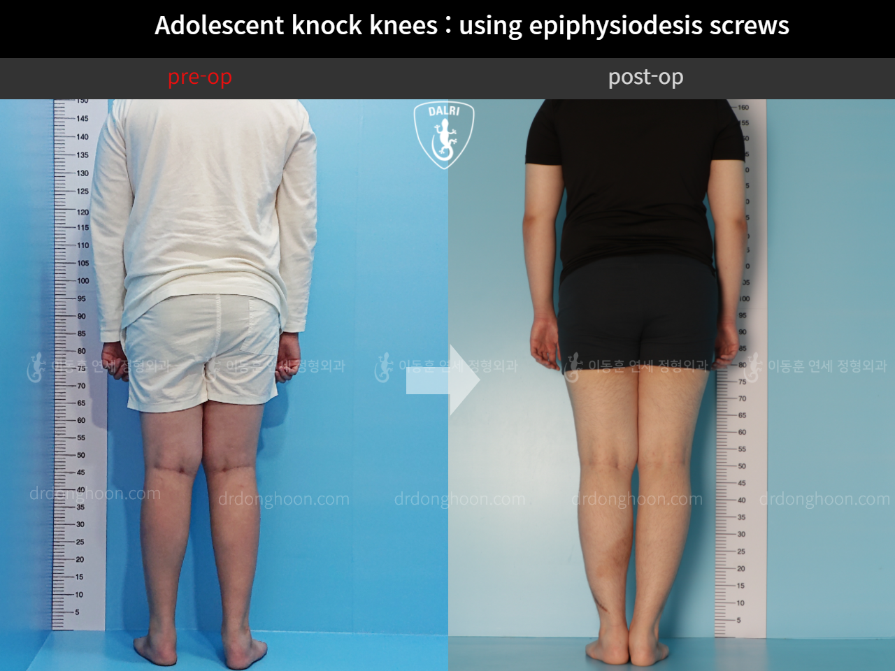 Before and after paediatric & adolescent knock knees, case 4310914, image 2, Dr. Donghoon institute (DALRI)