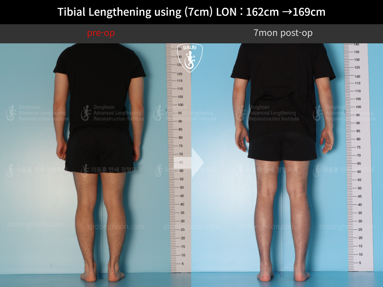 Before and after cll lon, case 13743472, image 4, Dr. Donghoon institute (DALRI)