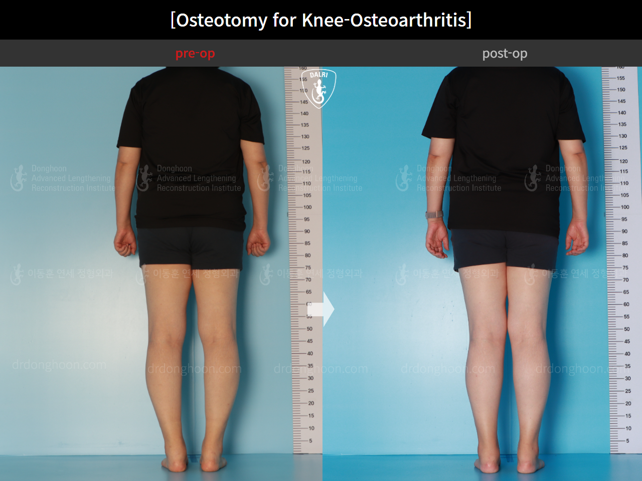 Before and after osteotomy for knee osteoarthritis, case 15944917, image 5, Dr. Donghoon institute (DALRI)