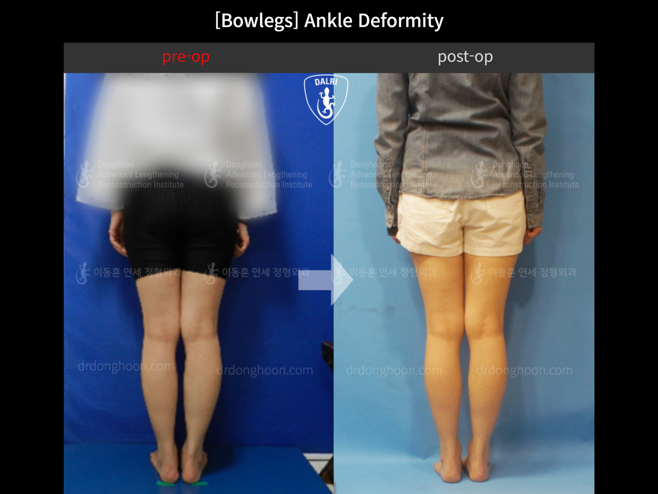 Before and after foot & ankle deformity, case 12754696, image 3, Dr. Donghoon institute (DALRI)