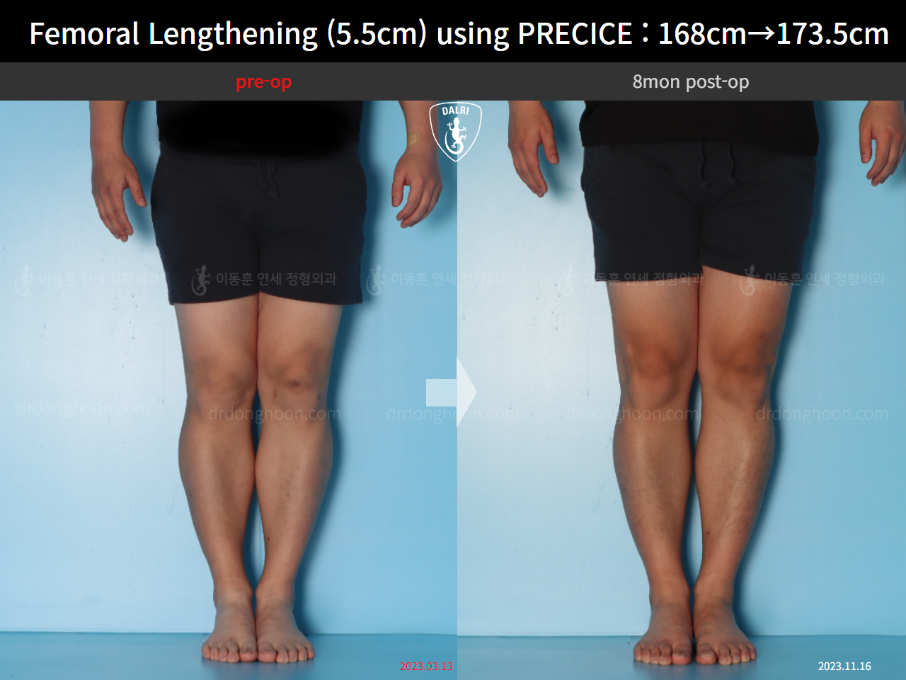 Before and after cll precice, case 16910900, image 7, Dr. Donghoon institute (DALRI)