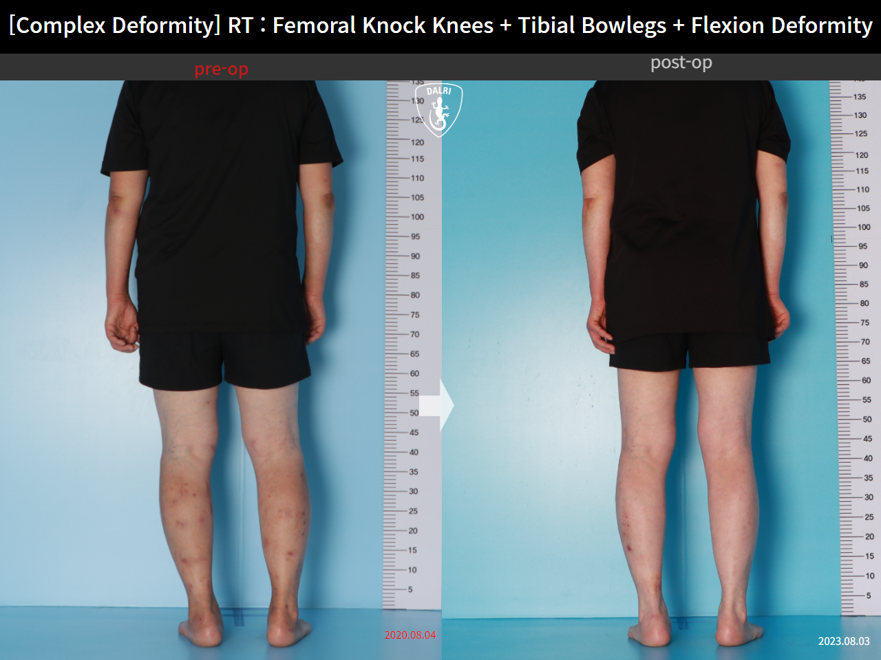 Before and after complex deformity, case 16507040, image 4, Dr. Donghoon institute (DALRI)