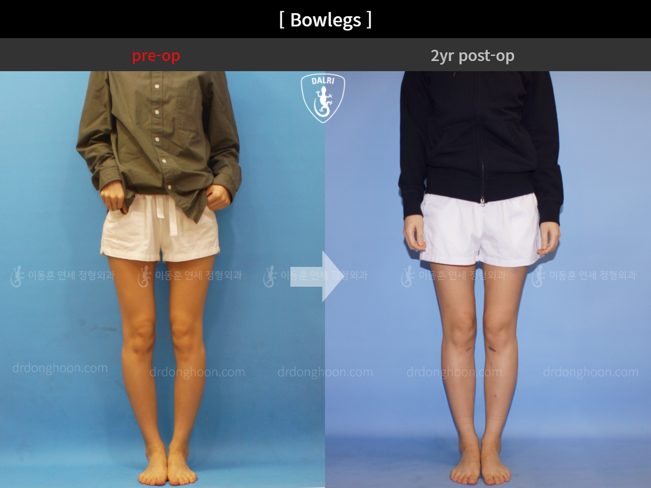 Before and after adult bowlegs, case 4311371, image 3, Dr. Donghoon institute (DALRI)