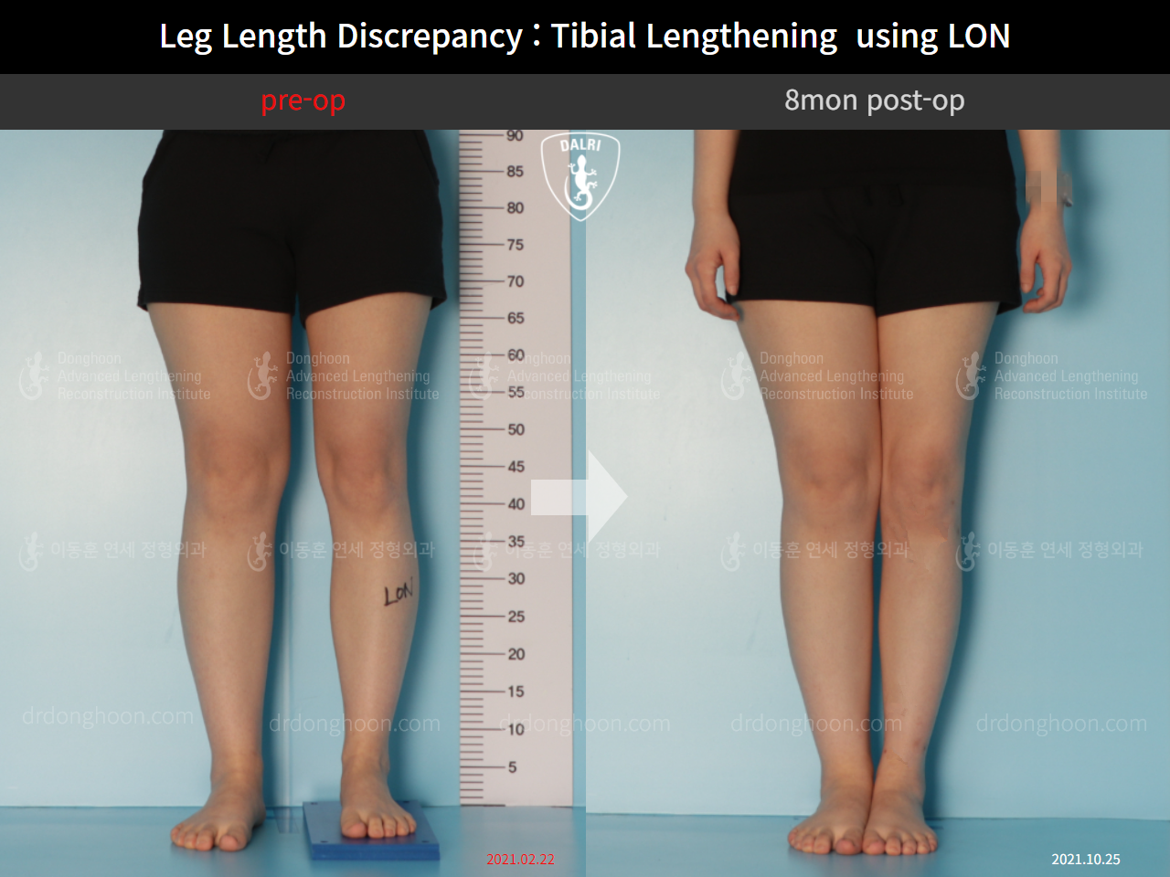 Before and after adult lld, case 10477860, image 4, Dr. Donghoon institute (DALRI)