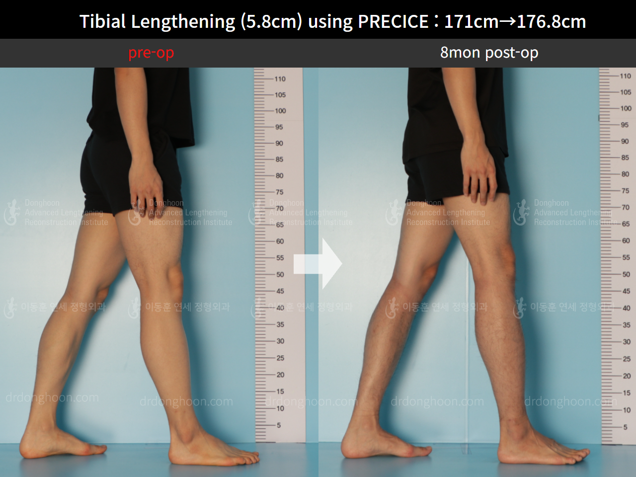 Before and after cll precice, case 8678696, image 7, Dr. Donghoon institute (DALRI)