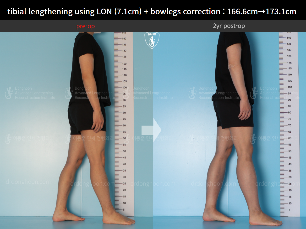 Before and after cll lon, case 14678740, image 4, Dr. Donghoon institute (DALRI)