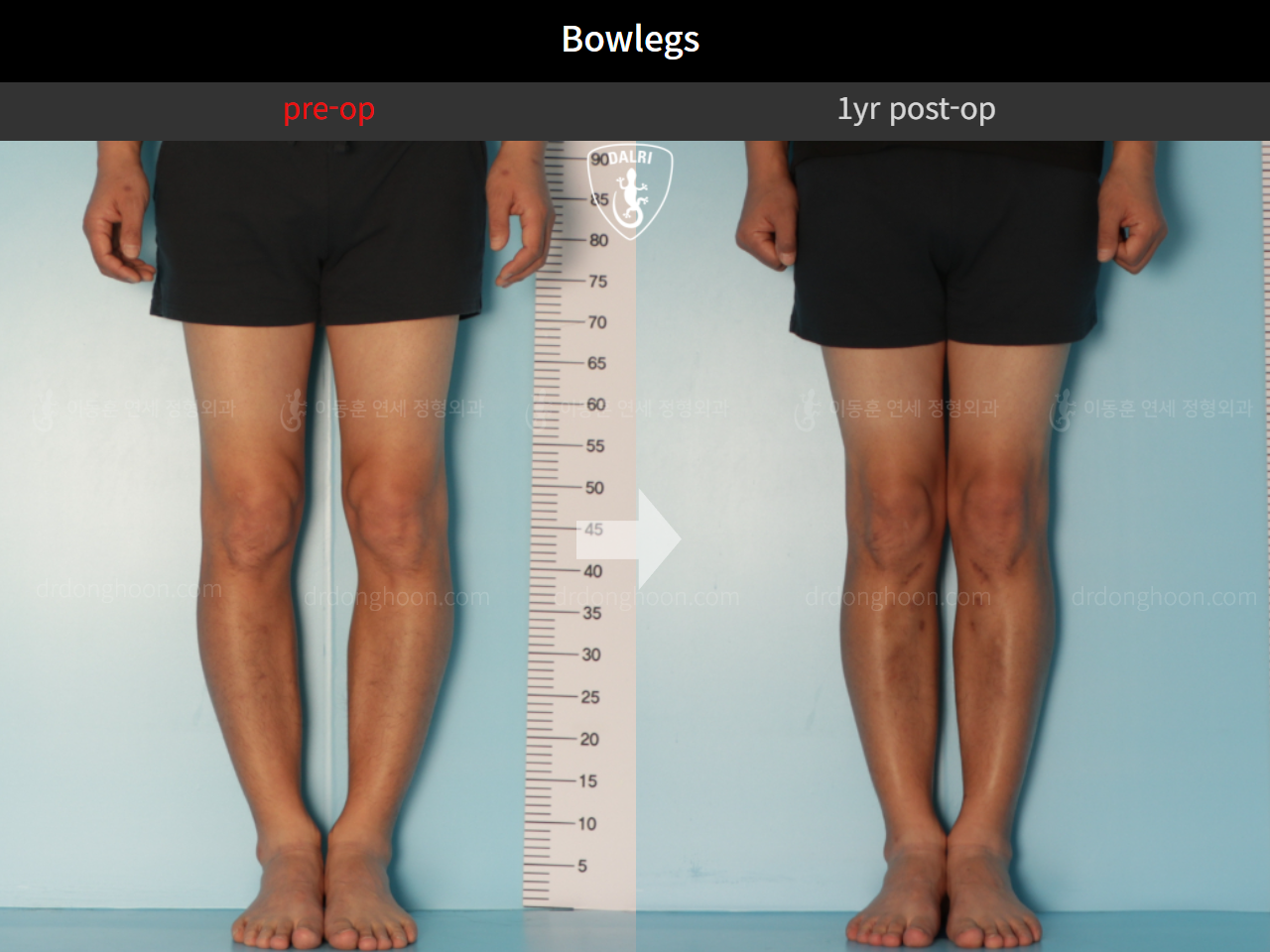 Before and after adult bowlegs, case 9487634, image 3, Dr. Donghoon institute (DALRI)