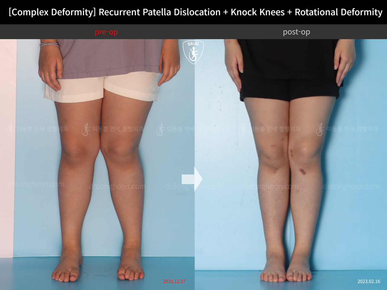 Before and after recurrent patella dislocation, case 14344405, image 3, Dr. Donghoon institute (DALRI)