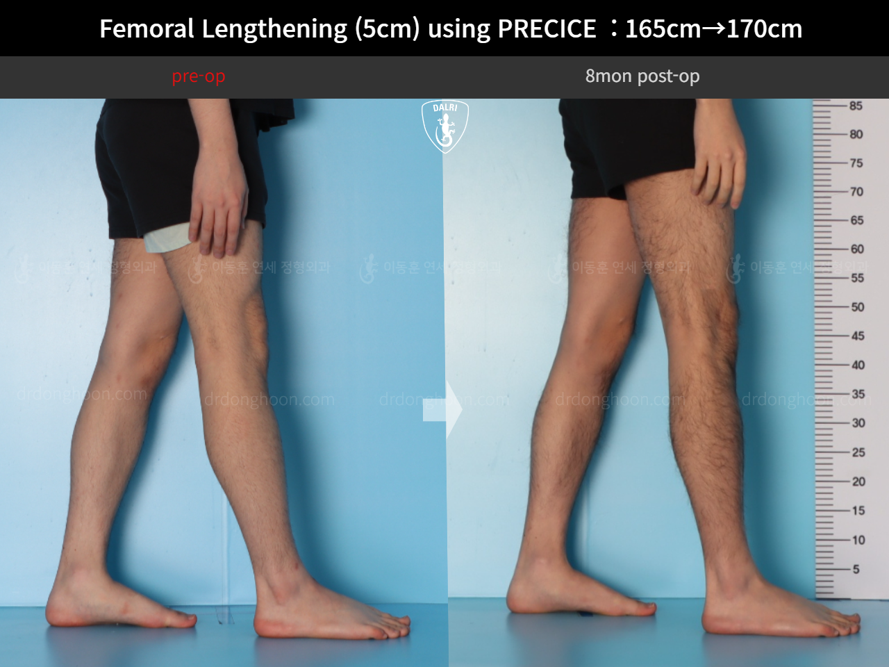 Before and after cll precice, case 18356944, image 10, Dr. Donghoon institute (DALRI)