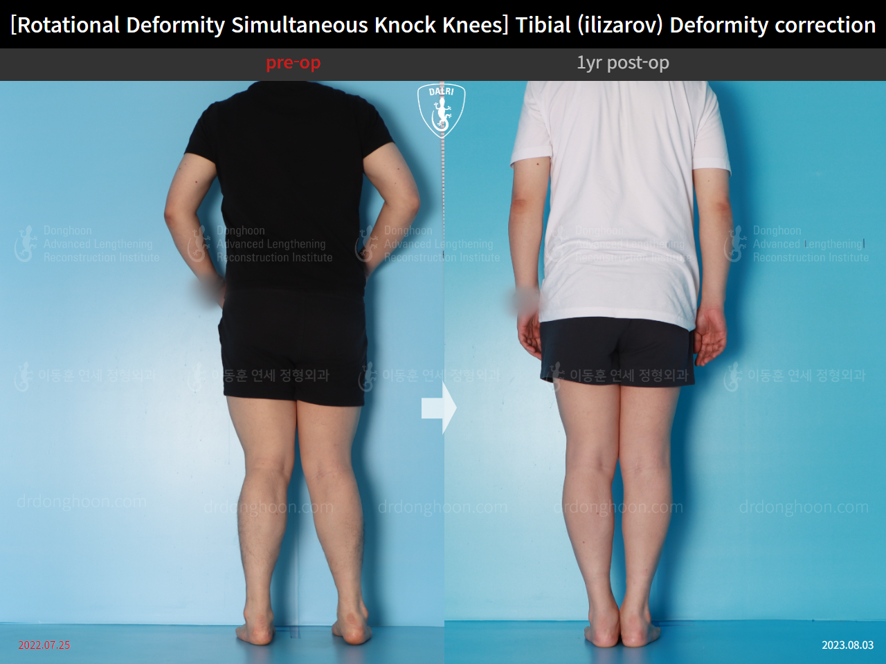 Before and after adult knock knees, case 15977455, image 2, Dr. Donghoon institute (DALRI)