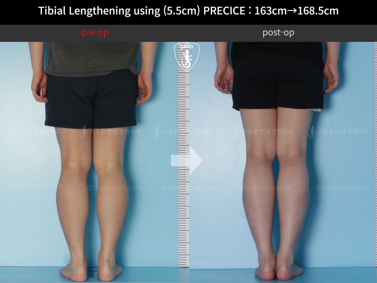 Before and after cll precice, case 12336162, image 5, Dr. Donghoon institute (DALRI)