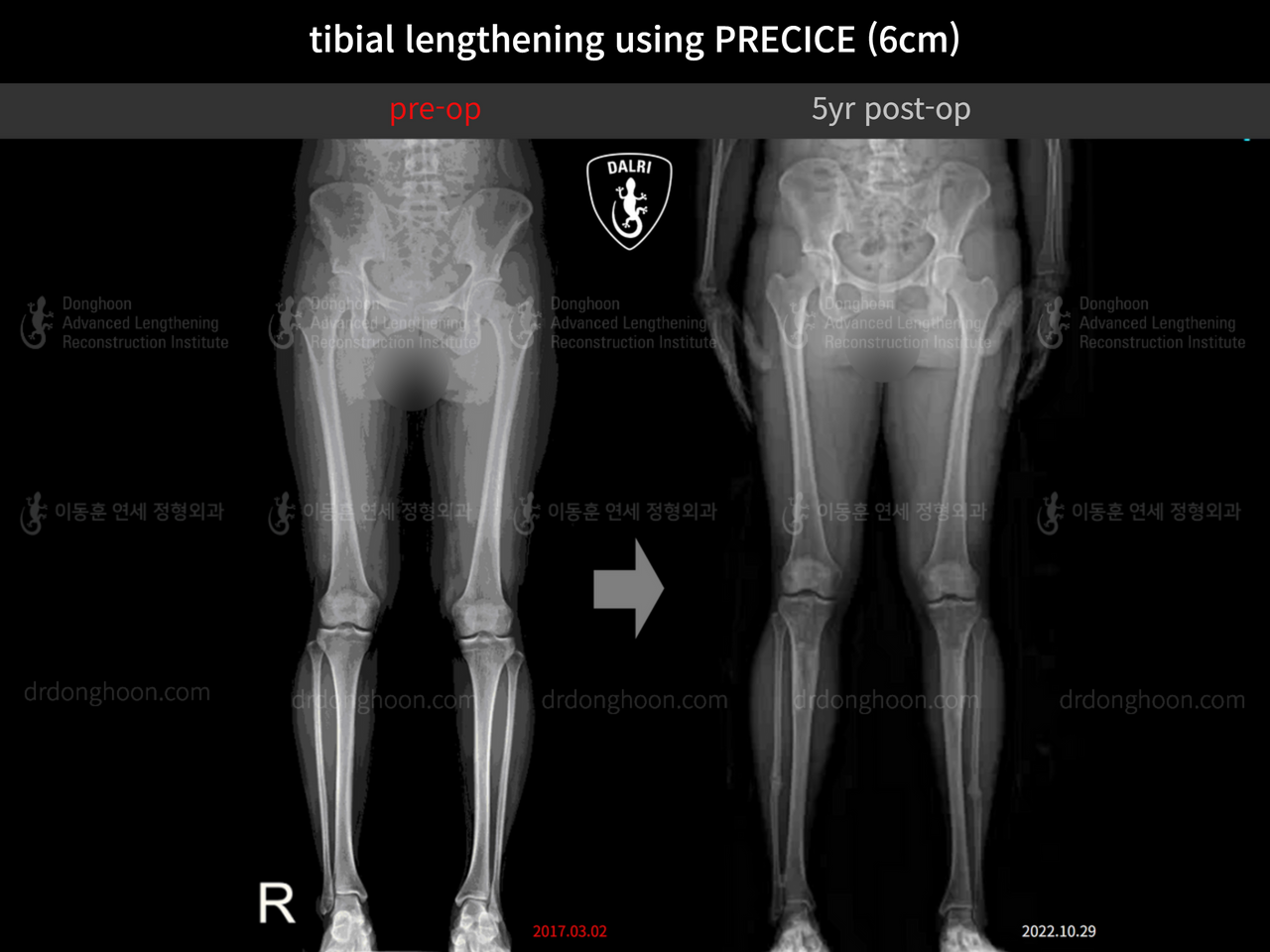 Before and after cll precice, case 13566787, image 2, Dr. Donghoon institute (DALRI)