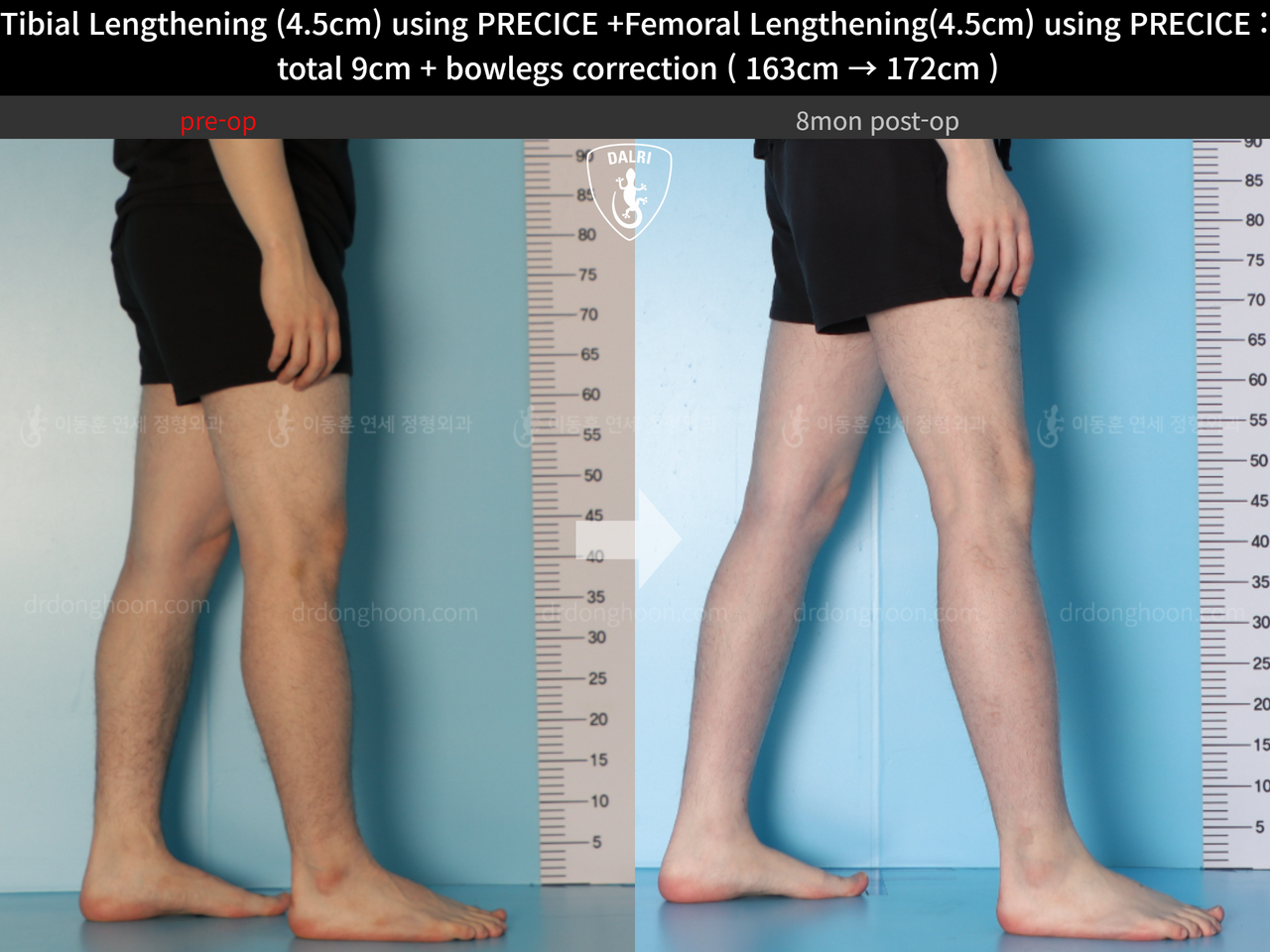 Before and after cll precice, case 13912585, image 12, Dr. Donghoon institute (DALRI)